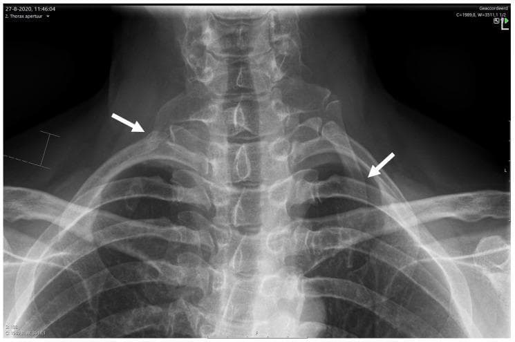 Anteroposterior (AP) X-ray of the lower cervical spine and thoracic inlet, demonstrating bilateral cervical ribs. A white arrow on the right side indicates a short, incomplete cervical rib arising from the C7 vertebra. A corresponding white arrow on the left side highlights a larger, complete cervical rib. Both accessory ribs show distinct articulation with the superior aspect of the first rib. The radiograph clearly visualizes the anatomical relationship between the cervical vertebrae, the thoracic aperture, and the clavicles. This finding is of clinical significance in the evaluation of Neurogenic Thoracic Outlet Syndrome (NTOS) and Gilliatt-Sumner hand, as these congenital anomalies can lead to compression of the lower trunk of the brachial plexus or subclavian vessels within the scalene triangle. The image provides an essential diagnostic baseline for multidisciplinary care pathways in orthopedic and neurological assessment.
