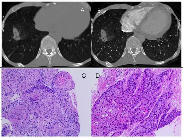 This composite figure illustrates the diagnostic findings for lung squamous cell carcinoma through radiological and histopathological imaging. Panels (A) and (B) show axial computed tomography (CT) scans of the thorax. Panel (A) is a non-contrast CT, and (B) is a contrast-enhanced CT, both revealing a spiculated mass measuring approximately 35 x 20 mm in the lower right lung lobe. The mass exhibits heterogeneous density and irregular, radiating margins characteristic of malignancy. Panels (C) and (D) present histopathological images of an endobronchial biopsy specimen stained with hematoxylin and eosin (H&E). The microscopy reveals nests of atypical squamous cells infiltrating the lung parenchyma. The cells show enlarged, hyperchromatic nuclei, prominent nucleoli, and a high nuclear-to-cytoplasmic ratio. While the cellular arrangement into well-defined nests is diagnostic of squamous cell carcinoma, there is a notable absence of overt keratin pearls or intercellular bridges in these specific fields. This educational material integrates macroscopic imaging findings with microscopic cellular architecture to demonstrate the presentation of primary lung cancer.