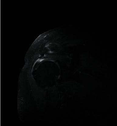 This diagnostic image is a magnetic resonance imaging (MRI) scan of the human shoulder joint, specifically an oblique coronal view utilizing fat-suppression techniques (likely SPAIR). The image clearly depicts the glenohumeral joint anatomy, featuring the rounded humeral head situated within the glenoid cavity. Anatomical landmarks include the acromion process superiorly and the surrounding rotator cuff musculature. A focal area of concern is localized within the supraspinatus tendon, where abnormal signal intensity is observed. This hyperintense (bright) signal contrast against the typically hypointense (dark) tendon fibers suggests pathology such as a partial-thickness tear, tendinosis, or associated inflammatory edema. The educational value of this image lies in its demonstration of MRI signal characteristics used to diagnose rotator cuff injuries and the evaluation of tendon integrity relative to adjacent bony structures like the humeral head and acromion.