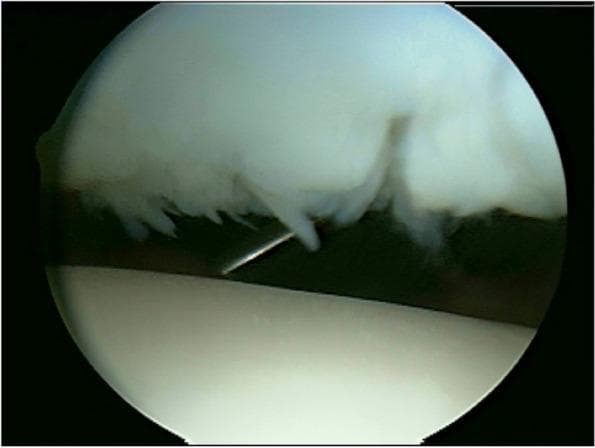 This arthroscopic diagnostic image displays a high-grade chondral lesion on the lateral facet of the patella within the knee joint. The visual focus is on a severe, Grade 4 International Cartilage Repair Society (ICRS) injury, characterized by full-thickness cartilage loss and significant structural degradation. The remaining cartilage edges exhibit marked fraying, fibrillation, and irregular, shaggy textures, indicating advanced chondromalacia. A metallic surgical probe is visible, partially inserted beneath a frayed flap of cartilage to assess the depth, stability, and extent of the delamination. The underlying subchondral bone appears exposed or minimally covered by necrotic debris in the depth of the defect. This image serves as a clinical example of severe patellofemoral degenerative disease, often requiring advanced regenerative procedures such as autologous chondrocyte implantation (ACI) or osteochondral allografts.