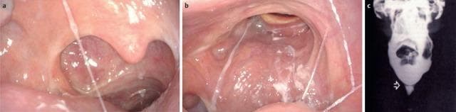 This composite educational clinical figure illustrates oropharyngeal and esophageal pathologies contributing to dysphagia. Image (a) is a transoral endoscopic view of an 87-year-old patient showcasing post-surgical changes following an extended partial resection of the right oropharynx and neck dissection. Visible features include a disrupted pharyngeal wall structure on the right and distorted mucosa consistent with radiotherapy and chemotherapy effects. Image (b) presents a transnasal endoscopic view of the velum and posterior oropharyngeal wall. It demonstrates significant scarring and asymmetrical contraction of the right-sided velum, with visible scar tissue extending across the posterior pharyngeal wall. Prominent white, viscous saliva is seen spanning the lumen, indicating impaired clearance and a transportation disorder. Image (c) is a contrast radiography (barium swallow) from a different patient, identifying tissue formations (indicated by an arrow) in the pharynx or esophagus that create mechanical obstacles. Together, these images teach how oncological treatments, scarring, and structural abnormalities disrupt the swallowing mechanism.