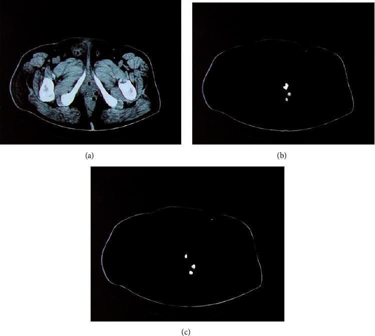 This composite diagnostic image demonstrates computerized tomography (CT) segmentation techniques for identifying a perianal abscess. Image (a) is an axial (transverse) CT slice of the pelvic and upper thigh region, showing high-density (white) femoral and pelvic bone structures, lower-density soft tissues, and the anal canal area where a perianal lesion is located. Images (b) and (c) present the results of automated lesion extraction using different machine learning models. Subfigure (b) shows the segmentation output of a standard Convolutional Neural Network (CNN), which identifies the abscess as scattered, less-defined white pixels against a masked dark background. Subfigure (c) demonstrates the result of a Deep Learning Fusion Convolutional Neural Network (DLFCNN) algorithm, showing a more precise and localized segmentation of the abscess tissue with reduced noise and clearer borders compared to the standard CNN. This comparison illustrates the clinical application of deep learning in radiology for the accurate classification and boundary delineation of soft tissue infections in the perianal region.