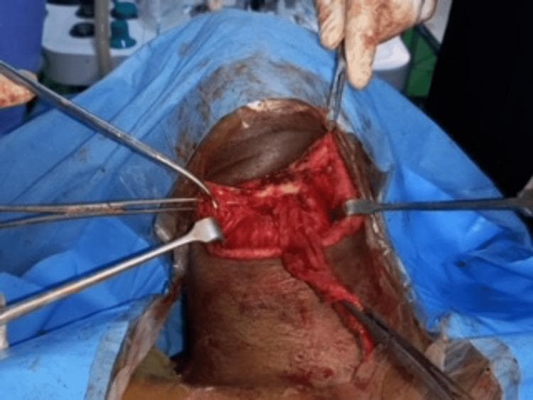 This intraoperative clinical photograph captures a surgical field during a Sistrunk procedure for a thyroglossal duct cyst. The image shows a transverse incision in the mid-anterior neck, framed by blue sterile drapes. Surgical instruments, including retractors and hemostatic forceps, are being used to expose and manipulate the underlying anatomy. Central to the operative field is the visualization of the mid portion of the hyoid bone, appearing as a light-colored, horizontal structure amidst the deep neck musculature and fascia. The surrounding strap muscles (sternohyoid and omohyoid) are reflected to allow for the resection of the cyst and the required central segment of the hyoid bone to prevent recurrence. Visible blood and tissue moisture indicate active surgical dissection. This image serves as a clinical reference for the anatomical landmarks and surgical steps involved in the management of midline cervical masses.