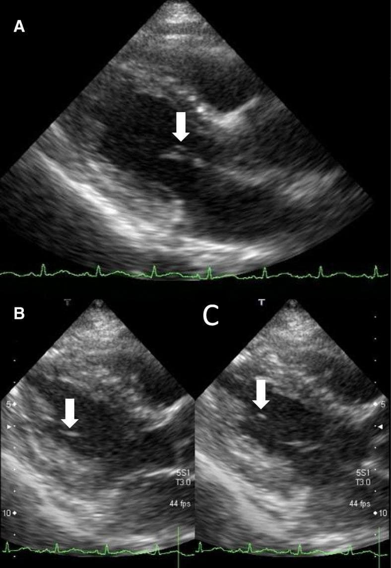 This set of diagnostic images consists of three transthoracic echocardiography (TTE) frames in the parasternal long-axis (PLAX) view, showcasing cardiac pathology associated with infective endocarditis. Panel A displays a 4 x 1 mm echogenic mass (vegetation) attached to the anterior leaflet of the mitral valve, indicated by a white arrow. Panels B and C capture different phases of the cardiac cycle, specifically presystole and end-diastole, highlighting a second, larger vegetation. This second mass is elongated and mobile, measuring approximately 10 x 2 mm, and is located on the chorda tendinea of the mitral valve. The images demonstrate classic ultrasonographic findings of endocardial vegetations, emphasizing their morphology, size, and anatomical attachment sites within the left ventricle. These features are critical for diagnosing infective endocarditis using clinical criteria such as the Modified Duke Criteria. The content is suitable for cardiology and internal medicine education, focusing on valvular heart disease and diagnostic ultrasound interpretation.