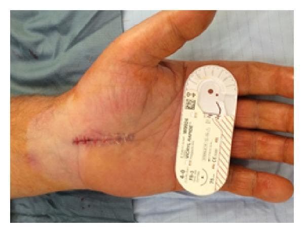A clinical photograph of a human hand showing a post-operative carpal tunnel release incision. The linear incision, approximately 3 cm in length, is located on the proximal palmar surface, extending from the distal wrist crease toward the mid-palm. The wound is closed using interrupted horizontal mattress sutures with visible, absorbable multifilament material (Vicryl Rapide), as indicated by the suture packaging placed adjacent to the hand for scale and material identification. The surgical site displays mild perisutural erythema and localized bruising distal to the incision line, which are typical early inflammatory findings. A transparent adhesive film dressing partially covers the proximal aspect of the surgical site. The image demonstrates standard surgical technique for carpal tunnel decompression and immediate postoperative wound appearance using absorbable suture material for skin closure in hand surgery.