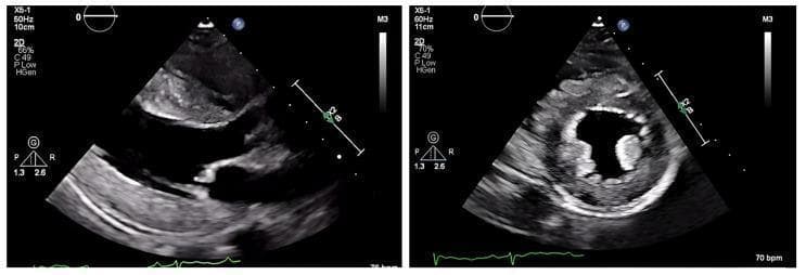 Two-dimensional transthoracic echocardiogram (ECHO) images demonstrating severe left ventricular hypertrophy (LVH). The image on the left shows a parasternal long-axis view, highlighting significant thickening of the interventricular septum and the posterior wall of the left ventricle. The image on the right displays a parasternal short-axis (transverse) view at the level of the papillary muscles, revealing concentric thickening of the myocardium and a resultant reduction in the left ventricular cavity size. The myocardial texture appears slightly speckled or echogenic, a visual finding often associated with infiltrative cardiomyopathies such as cardiac amyloidosis. Both views show a small pericardial effusion visible as an echo-free space posterior to the left ventricle. Annotation scales (10cm and 11cm depth) and transducer settings (X5-1, 50-60Hz) are visible on the periphery. This educational visual is used to differentiate between structural wall mass increases on imaging and the low-voltage electrical activity typically seen on an electrocardiogram in patients with hATTR cardiac amyloidosis.