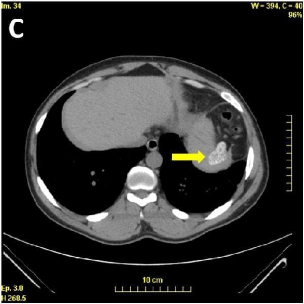 This diagnostic image is an axial slice from a non-contrast-enhanced computed tomography (CT) scan of the upper abdomen. The visual focus, indicated by a yellow arrow, demonstrates a classic presentation of autosplenectomy secondary to sickle cell disease (S/β+ sickle cell syndrome). The spleen is markedly atrophic, reduced to a small, shrunken, and irregularly shaped remnant located in the left upper quadrant. It exhibits diffuse, high-density mottled calcifications, giving it a speckled or heterogeneous appearance. Surrounding anatomical structures include a normally appearing liver in the right upper quadrant, the stomach, and vertebral bodies. The clinical significance of these findings lies in the demonstration of splenic infarction and subsequent fibrosis and calcification over time, a common complication in sickle cell syndromes that leads to functional asplenia. This imaging is often prompted by the finding of Howell-Jolly bodies on a peripheral blood smear.
