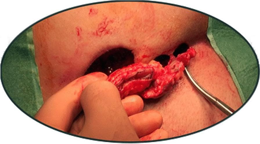This clinical photograph captures an intraoperative view of a pilonidal sinus excision utilizing a modified Lord-Millar technique. The image demonstrates multiple distinct, circular surgical openings in the sacrococcygeal region, where a skin bridge has been intentionally preserved between the excision sites to facilitate healing by secondary intention. A gloved hand is visible holding a segment of excised, erythematous tissue, likely containing the pilonidal cyst or sinus tract. A metallic surgical probe or dissector is inserted into one of the smaller openings, assisting in the exploration or dissection of the tract. The surrounding skin shows post-surgical erythema and inflammation. This visual illustrates the surgical principle of limited excision and the preservation of healthy skin bridges to reduce the overall wound surface area while ensuring the complete removal of the pathological sinus, a key concept in proctological and dermatological surgery for pilonidal disease.