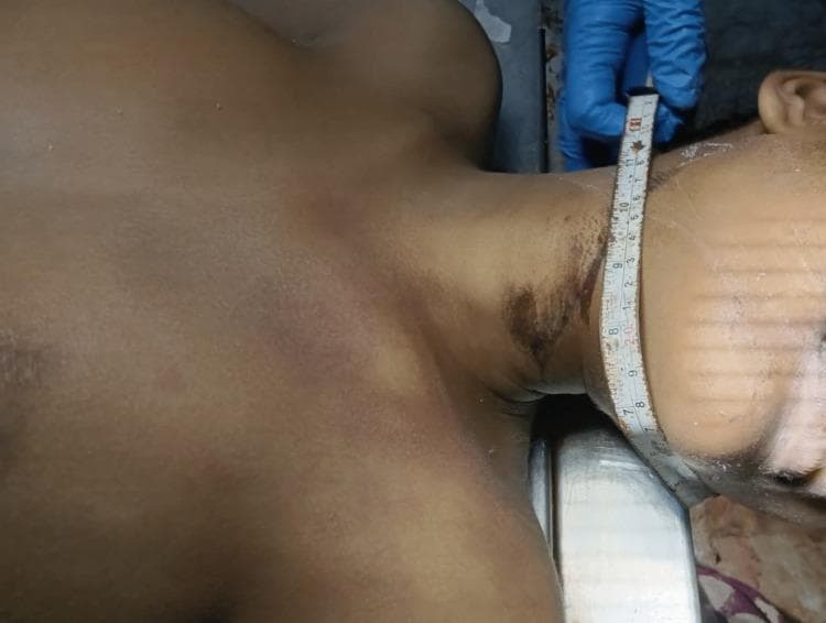 A clinical photograph and forensic pathology record showing a ligature mark on the neck of a deceased individual during a medicolegal postmortem examination. The image displays a dark brown, non-continuous ligature furrow located on the upper portion of the neck, situated above the thyroid cartilage. The mark follows an oblique path, ascending toward the lower jaw and mastoid region. Visually, the base of the furrow appears hard, leathery, and parchment-like, characterized by localized skin excoriation and irregular hyperpigmentation. A measuring tape is held against the neck by a gloved hand to document the dimensions and placement of the mark. The surrounding skin shows varying degrees of postmortem discoloration. This image is significant in forensic medicine for documenting features of hanging or suspension and distinguishing antemortem ligature marks from other forms of neck trauma.