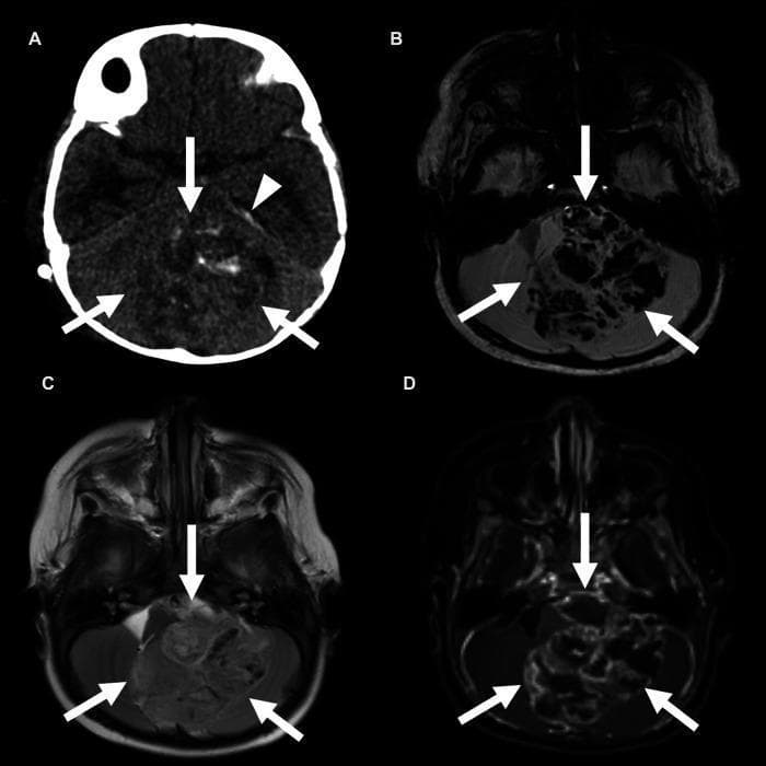 This composite of four axial neuroimaging views (CT and MRI) demonstrates a large, complex posterior fossa mass in a pediatric patient, characteristic of a Group A ependymoma. Image (A), a non-contrast CT, shows a predominantly isodense to hyperdense mass causing significant effacement of the fourth ventricle. Image (B), an axial Susceptibility Weighted Imaging (SWI) MRI, reveals extensive dark blooming artifacts within the lesion, indicating internal hemorrhage or calcification. Image (C), a T2-weighted MRI, shows the mass is largely isointense to the adjacent brain parenchyma with some heterogeneous internal architecture. Image (D), a contrast-enhanced MRI, demonstrates prominent heterogeneous enhancement of the solid tumor components. An arrowhead in the CT scan identifies hyperdense subdural blood products along the left tentorium. The mass occupies a significant portion of the posterior fossa, exerting mass effect on the surrounding cerebellum and brainstem. These imaging features—location in the posterior fossa, hemorrhage on SWI, and heterogeneous enhancement—are key diagnostic indicators for differentiating pediatric intracranial tumors.