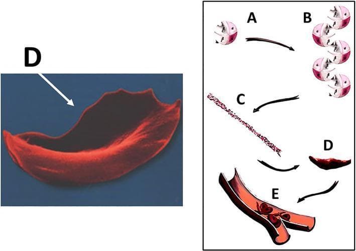 This educational graphic illustrates the molecular and cellular pathophysiology of sickle cell disease (SCD) leading to vaso-occlusion. The diagram is divided into a microscopic anatomical illustration and a high-magnification scanning electron micrograph. Steps A through D depict the hemoglobin S (HbS) polymerization process: (A) individual deoxygenated hemoglobin tetramers, (B) aggregation of hemoglobin molecules, (C) formation of long, rigid hemoglobin polymers or strands, and (D) the resulting transformation of a flexible biconcave red blood cell into a rigid, crescent or sickle-shaped erythrocyte. A corresponding scanning electron micrograph (labeled D) highlights the characteristic elongated, spicular morphology of a sickled cell. Section E shows a cross-section of a small bifurcating blood vessel where these rigid, abnormally shaped cells are aggregating, causing mechanical obstruction (vaso-occlusion) of the lumen. This process demonstrates the mechanism behind tissue ischemia and subsequent complications such as osteonecrosis in SCD patients. The content is suitable for medical students and clinicians studying hematology and musculoskeletal pathology.