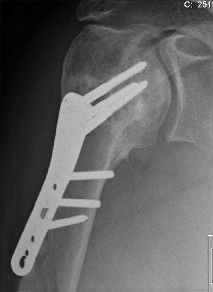 Anteroposterior (AP) radiograph of the right shoulder demonstrating a malunion of a proximal humeral fracture at nine months post-initial stabilization. A proximal humeral locking plate is fixed to the lateral aspect of the humerus, with multiple cortical screws in the shaft and locking screws extending into the humeral head. The humeral head shows significant articular surface irregularity and flattening, consistent with partial collapse and malunion. A prominent bony spur is visible at the superior aspect of the head, likely contributing to mechanical impingement. While the metallic hardware appears intact without acute fracture of the plate or visible screw breakage, the relative alignment of the humeral head to the shaft demonstrates a varus deformity. The glenohumeral joint space appears preserved, but the loss of normal articular congruity is evident. This image illustrates post-traumatic complications of proximal humerus fractures, specifically hardware-associated malunion and secondary morphological changes of the humeral head.