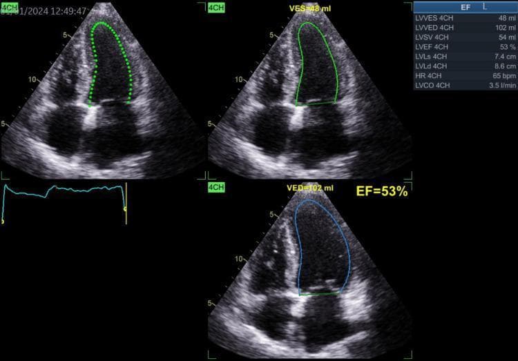 An echocardiogram in the apical four-chamber (4CH) view, displaying left ventricular (LV) volume measurements and systolic function assessment using the Simpson's method of disks. The panel contains three ultrasound frames illustrating the LV tracing in different cardiac phases. The end-diastolic volume (LVVED) is outlined in blue at 102 ml, while the end-systolic volume (LVVES) is outlined in green at 48 ml. Quantitative data presented in the overlay includes a stroke volume (LVSV) of 54 ml and a preserved ejection fraction (LVEF) of 53%. Anatomical longitudinal measurements show an end-diastolic length (LVLd) of 8.6 cm and an end-systolic length (LVLs) of 7.4 cm. Additional hemodynamic data indicates a heart rate of 65 bpm and a calculated cardiac output (LVCO) of 3.5 l/min. This diagnostic image is used in cardiology for assessing ventricular wall motion, volume status, and global systolic performance in patients with conditions such as heart failure or valvular disease.