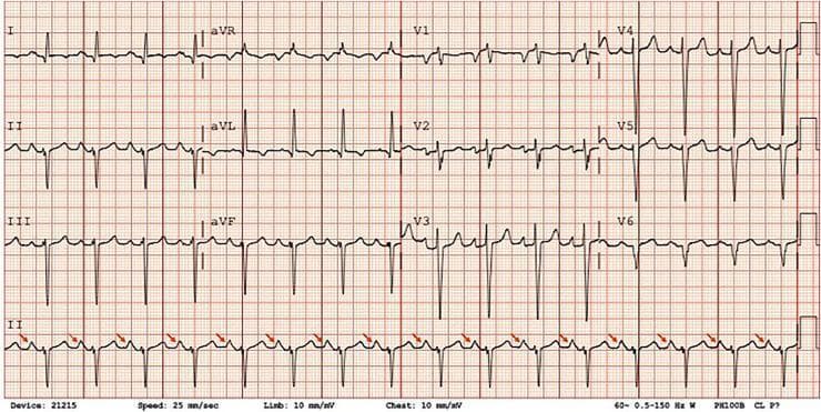 A 12-lead electrocardiogram (ECG) demonstrating a regular sinus rhythm with significant morphological abnormalities indicative of cardiac chamber enlargement. The tracing shows peaked, high-amplitude P waves (P pulmonale) most prominent in lead II, marked by red arrows, suggesting right atrial enlargement. Additionally, the biphasic P wave morphology in lead V1 with a prominent terminal negative component indicates concurrent left atrial enlargement, collectively representing bi-atrial enlargement. The QRS complexes exhibit high voltage in the precordial leads, specifically deep S waves in V1-V3 and tall R waves in V4-V6, meeting Sokolow-Lyon criteria for left ventricular hypertrophy (LVH). Secondary ST-segment and T-wave abnormalities (LV strain pattern) are visible in the lateral leads (I, aVL, V5-V6). The tracing is captured at a standard paper speed of 25 mm/sec and calibration of 10 mm/mV, serving as a classic educational example of multi-chamber enlargement secondary to chronic cardiac pressure or volume overload.