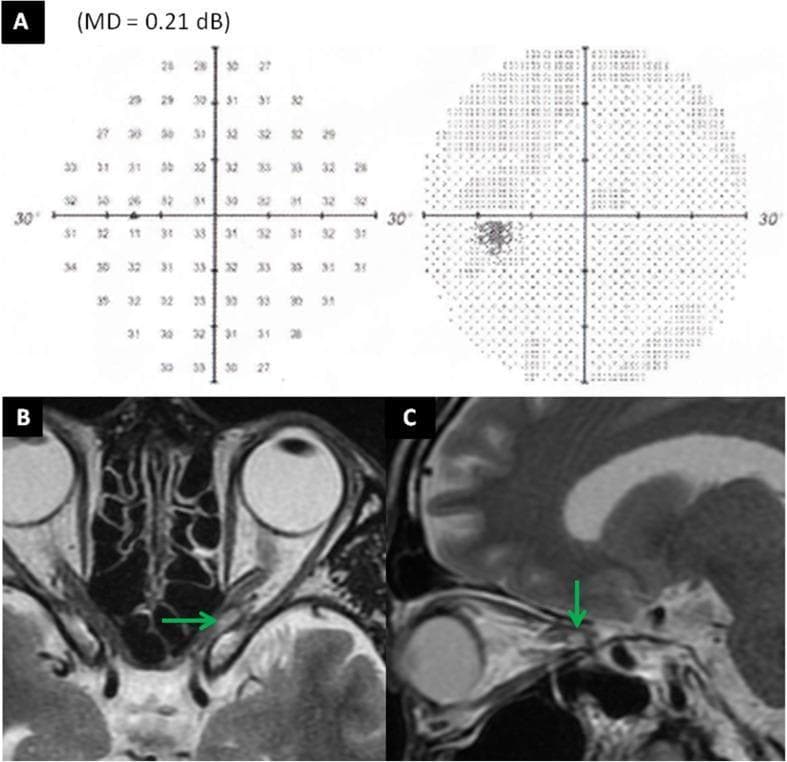Educational panel combining Humphrey automated perimetry (HAP) and MRI findings in a case of optic nerve sheath meningioma (ONSM). Panel A displays a 30-2 visual field test result showing near-normal sensitivity thresholds (dB) and a Mean Deviation (MD) of 0.21 dB, representing complete resolution of a previous visual field defect following radiotherapy. Panels B and C are T2-weighted magnetic resonance images (MRI) in axial and sagittal planes, respectively. The axial view (B) demonstrates a persistent fusiform enlargement of the left optic nerve with characteristic tortuosity ('winding'). A green arrow points to a residual, well-defined mass with altered signal intensity located at the precanalicular portion of the distal optic nerve. The sagittal view (C) shows the longitudinal extent of the tumor along the optic nerve sheath. Despite the significant functional recovery shown in the visual field test, the imaging confirms only partial radiological regression of the tumor post-treatment. These images illustrate the potential dissociation between functional visual recovery and anatomical tumor volume reduction following intensity-modulated radiotherapy (IMRT).