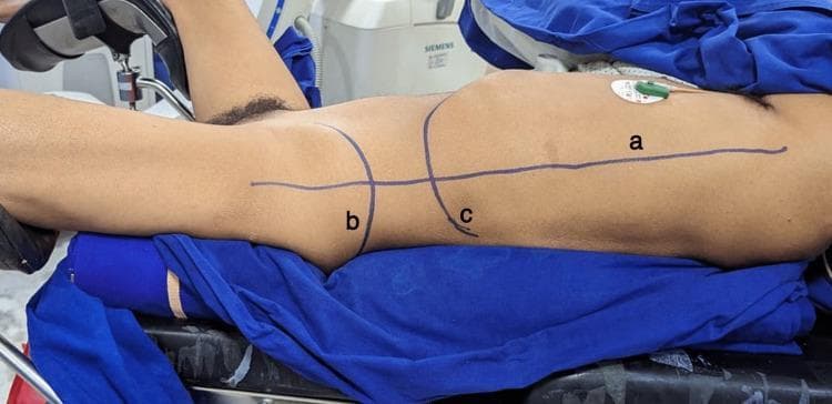 A clinical procedural photograph illustrating the Galdakao-modified supine Valdivia position for percutaneous nephrolithotomy (PCNL). The patient is placed in a modified supine position on a surgical table with blue drapes, utilizing stirrups for leg positioning: the ipsilateral leg is extended straight, while the contralateral leg is flexed and abducted. Bolsters are placed under the hip and chest to elevate the flank, providing surgical access to the renal area. Surface anatomy markings in purple ink identify critical landmarks for the procedure: (a) the posterior axillary line, (b) the iliac crest, and (c) the level of the 12th rib. An ECG electrode is visible on the chest wall. This image serves as an educational guide for urological surgical positioning, demonstrating the necessary surface markers and table configuration required to safely perform supine renal access for stone management.