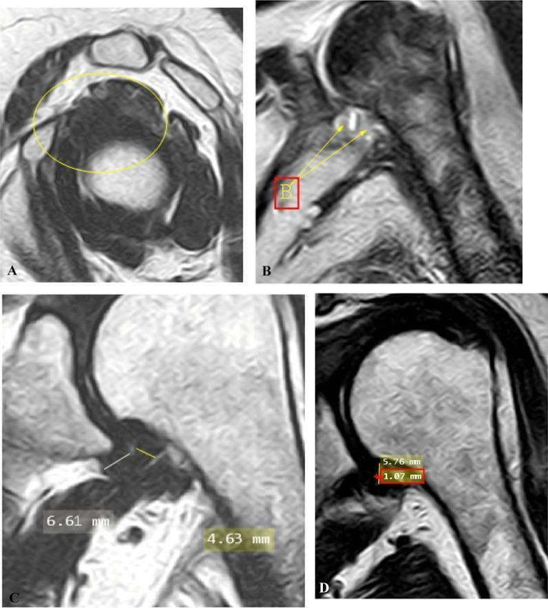 This composite of four magnetic resonance imaging (MRI) panels demonstrates diagnostic features of adhesive capsulitis (frozen shoulder) in the left shoulder. (A) Oblique sagittal T2-weighted MRI shows complete obliteration of the subcoracoid fat triangle (yellow circle), with an absence of normal fat planes and the coracohumeral ligament. (B) Oblique coronal fat-suppressed proton density (PD)-weighted image highlights hyperintense signal (arrows) indicating edema at both the glenoid and humeral insertions of the axillary recess. (C) Oblique coronal T2-weighted image demonstrates quantitative assessment of joint capsule thickening, measuring 6.61 mm at the glenoid portion and 4.63 mm at the humeral portion of the axillary recess. (D) Oblique coronal T2-weighted image shows the measurement of the maximal height (5.76 mm) and width (1.07 mm) of the axillary recess. These findings collectively illustrate key radiological markers used to stage and diagnose inflammatory and fibrotic changes in the glenohumeral joint capsule and surrounding rotator interval.