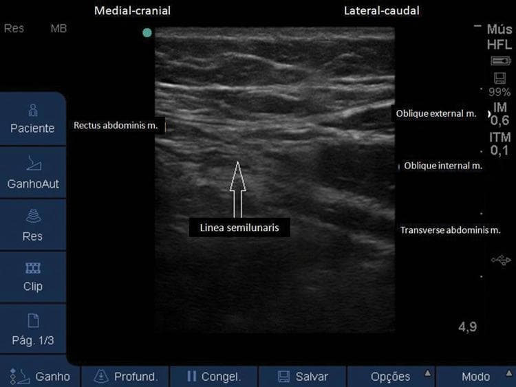 A diagnostic ultrasound image of the anterolateral abdominal wall, demonstrating the musculofascial anatomy in a transverse view. The image illustrates the transition between the medial and lateral abdominal muscle groups. On the left (medial-cranial aspect), the rectus abdominis muscle is identified by its characteristic fusiform shape. Centrally, an arrow points to the linea semilunaris, which represents the aponeurotic transition zone where the lateral abdominal muscles meet the rectus sheath. To the right (lateral-caudal aspect), three distinct muscular layers are visualized from superficial to deep: the external oblique muscle, the internal oblique muscle (often the most prominent layer), and the transverse abdominis muscle. These hypoechoic muscle layers are separated by hyperechoic fascial planes. This imaging is clinically significant for performing ultrasound-guided regional anesthesia, such as the Transversus Abdominis Plane (TAP) block or rectus sheath block, by identifying the specific intermuscular planes for anesthetic injection.