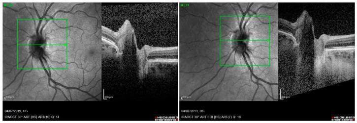 Diagnostic optical coherence tomography (OCT) imaging of the optic nerve head and peripapillary region, presented as a side-by-side comparison between standard spectral-domain OCT (left) and enhanced depth imaging (EDI) OCT (right). Both panels include an infrared fundus photograph with a green reference line indicating the scan location and a corresponding cross-sectional B-scan. The primary finding is a peripapillary hyperreflective ovoid mass-like structure (PHOMS) located at the optic disc margin. This structure is characterized by a high-reflectivity signal situated superficial to the Bruch's membrane and beneath the retinal nerve fiber layer, appearing as an elevated, rounded protrusion. The EDI acquisition on the right provides superior visualization of the deeper choroidal architecture and the posterior border of the optic nerve excavation compared to the standard scan on the left, which exhibits more rapid signal attenuation in the deep tissues. These images are used to differentiate PHOMS from optic disc drusen and to evaluate anatomical variations of the optic disc head.
