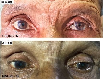 Two-panel clinical photograph displaying the 'Before' and 'After' ophthalmic findings in a patient with left-sided Horner's syndrome. The 'Before' image (Figure 3a) demonstrates classic clinical signs including left upper eyelid ptosis (drooping) and left-sided miosis (constricted pupil) compared to the right eye. The 'After' image (Figure 3b) illustrates the clinical response following three cycles of chemotherapy for an underlying superior sulcus tumor (Pancoast tumor). There is visible improvement in the left ocular presentation, characterized by the elevation of the left upper eyelid, reduction in ptosis severity, and a comparative increase in left pupil diameter (resolution of miosis). The image highlights the ocular manifestations of sympathetic nerve pathway disruption and its subsequent recovery during systemic treatment of the primary thoracic malignancy. Educational focus includes the recognition of Horner's syndrome triad (ptosis, miosis, and anhidrosis) and its clinical association with apical lung lesions.