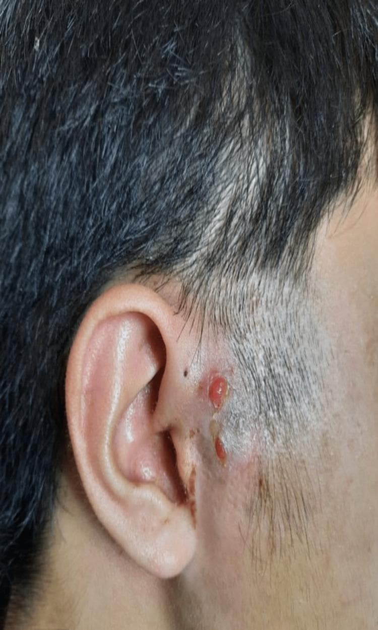 This clinical photograph shows a close-up of the right preauricular region and the adjacent pinna. The image displays a healing wound characterized by the formation of healthy, beefy red granulation tissue. The tissue appears raised, moist, and slightly lobulated (cobblestone appearance), indicative of active angiogenesis and the proliferative phase of wound healing. The granulation tissue is located near a preauricular sinus opening, which is visible as a small punctum. The surrounding perilesional skin exhibits signs of resolving inflammation, including mild erythema and localized hyperpigmentation. There is evidence of previous surgical intervention or drainage in the area, with some crusting and scabbing noted along the wound margins. The anatomical context and clinical presentation are consistent with a postoperative review of a preauricular sinus abscess, potentially secondary to tuberculous infection as indicated by the context. This image serves as a clinical example of secondary intention wound healing and common complications associated with congenital preauricular sinuses.