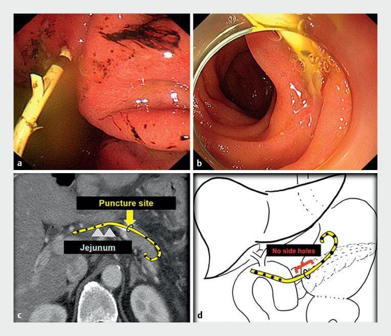 This composite educational graphic illustrates a case of endoscopic ultrasound-guided pancreatic duct drainage (EUS-PDD) and a subsequent complication. Panels (a) and (b) present endoscopic views showing a plastic pancreatic stent within the gastrointestinal tract. In (a), the gastric side view reveals the stent with side holes visible outside the duct, surrounded by erythematous, irritated mucosa with minor dark spots. In (b), the jejunal side view shows the stent emerging through healthy-appearing mucosa. Panel (c) is a coronal CT scan with a superimposed illustration showing the pigtail stent traversing from the jejunum into the pancreatic parenchyma. The puncture site is highlighted, demonstrating the curved path of the perforated stent. Panel (d) provides a schematic anatomical diagram illustrating the malposition of the stent; it highlights that the drainage holes are located outside the pancreatic duct near the anastomotic site, explaining the mechanism of ductal occlusion and subsequent acute pancreatitis. This set serves as a teaching tool for interventional gastroenterology regarding stent placement accuracy and troubleshooting in surgically altered anatomy.
