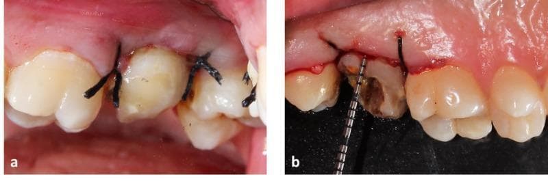 This composite clinical photograph displays two intraoral views of the upper left maxillary quadrant during a crown lengthening procedure for a second molar. Image (a) presents the buccal view, showcasing the placement of multiple simple interrupted sutures using dark-colored 3-0 braided silk. The sutures are positioned interdentally to approximate the gingival flap margins and adapt the soft tissue tightly against the cervical area of the teeth. Image (b) shows the palatal view of the same second molar, revealing a tooth with significant structural loss and dark carious discoloration. A calibrated periodontal probe is visible, measuring the clinical crown height or biological width. The surrounding gingival margins exhibit postoperative erythema and surgical irregularity consistent with recent internal bevel incision and flap elevation. These images demonstrate the surgical management of a compromised tooth to increase clinical crown height for future prosthetic restoration, emphasizing flap stabilization and periodontal measurement.