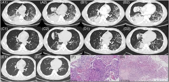 This composite educational graphic illustrates the longitudinal progression and histopathology of a complex pulmonary condition, later identified as tuberculosis presenting as acute fibrinous and organizing pneumonia (AFOP). Panels A1 through E2 are axial non-contrast chest CT scans showing a temporal series of pulmonary changes. Initial scans (A1, A2) reveal bilateral consolidations, ground-glass opacities (GGO) along bronchioles, and centrilobular nodules. Subsequent scans (B1, B2) show worsening density and distribution, followed by temporary resolution (C1, C2) and subsequent relapse (D1, D2) in multiple lobes. Final scans (E1, E2) demonstrate significant absorption of lesions. Panel F shows histopathology (H&E stain) indicating AFOP, characterized by fibrin deposition in alveolar spaces and granulation tissue proliferation. Panel G displays a necrotizing granuloma; the inset confirms acid-fast bacilli via Ziehl-Neelsen staining. This material demonstrates the radiographic evolution of infectious pneumonia and the diagnostic role of lung biopsy in distinguishing organizing pneumonia patterns from underlying mycobacterial infection.