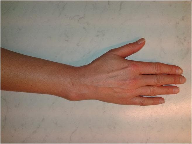 Clinical photograph showing a dorsal view of the right forearm, wrist, and hand of a 48-year-old female. The image demonstrates a significant structural abnormality at the distal forearm characterized by a prominent dorsal-radial convexity, consistent with a malunited distal radius fracture (Colles-type deformity). The wrist exhibits a 'dinner fork' like contour deviation where the distal fragment has healed with dorsal angulation. The skin over the deformity is intact without acute inflammatory signs, though superficial veins are visible on the dorsum of the hand. The fingers are held in a neutral, extended position with no apparent secondary digital deformities. This visual serves as an educational example of the long-term sequelae of non-surgically treated or inadequately reduced distal radius fractures, highlighting the functional and aesthetic impact of bone malunion in orthopedics.