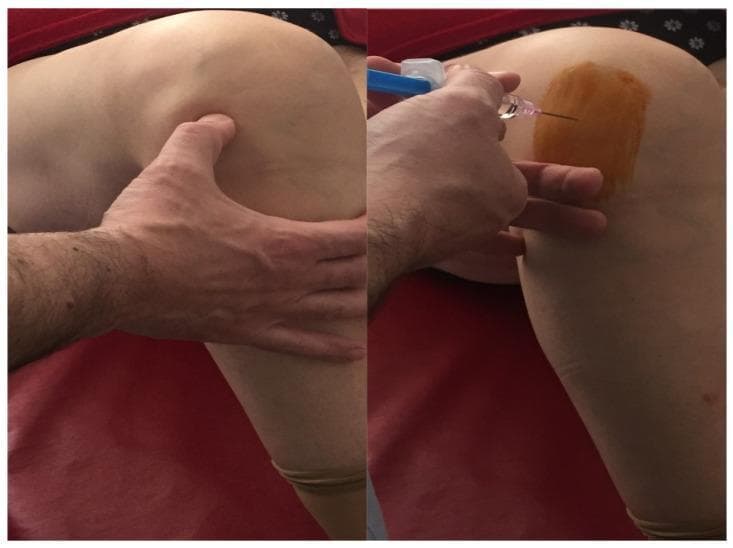 Clinical photograph in a split-frame view demonstrating an intra-articular injection procedure for the knee joint, specifically highlighting an anterolateral portal approach for hyaluronic acid administration in patients with osteoarthritis. The left frame shows the palpation of anatomical landmarks, with the clinician's hand identifying the patellar border and joint line to locate the appropriate entry point. The right frame illustrates the injection phase under aseptic conditions; the skin is prepared with a rectangular patch of povidone-iodine antiseptic solution. An 18-gauge needle attached to a syringe with a blue plunger is seen entering the lateral aspect of the joint space. The knee is positioned in slight flexion, which facilitates access to the joint cavity. This visual serves as an educational guide for orthopedic clinical skills, demonstrating proper site preparation, landmark identification, and needle orientation for viscosupplementation therapy.