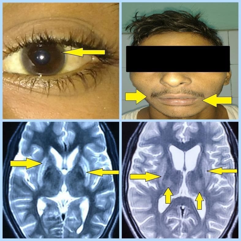 This composite figure illustrates the clinical and radiological hallmarks of Wilson's disease. The top-left clinical photograph shows a close-up of an eye with a yellow arrow pointing to a Kayser-Fleischer ring, characterized by a brownish-gold copper deposition at the corneal limbus. The top-right photograph depicts a patient with a 'mask-like facies' (hypomimia), noted by arrows pointing toward the mouth and facial muscles. The bottom panels consist of two axial MRI brain images (T2-weighted/FLAIR sequences). Yellow arrows indicate bilateral, symmetrical hyperintensities within the basal ganglia, specifically involving the lentiform nuclei (globus pallidus and putamen) and the thalami. These findings are highly characteristic of copper accumulation in the central nervous system and are critical for the diagnostic evaluation of hepatolenticular degeneration. The visual evidence correlates with neurological manifestations such as tremors and spasticity in pediatric or young adult patients.