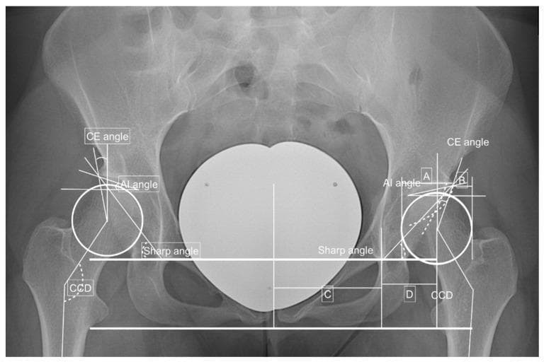 Anteroposterior (AP) pelvic radiograph demonstrating quantitative measurements for assessing hip joint morphology and Developmental Dysplasia of the Hip (DDH). The diagnostic image features bilateral annotations of key orthopedic angles: the Center-Edge (CE) angle (Wiberg's angle) for acetabular coverage, the Acetabular Index (AI) angle for the slope of the acetabular roof (Hilgenreiner’s line), and the Sharp angle for overall acetabular inclination. Additionally, the Caput-Collum-Diaphyseal (CCD) angle is marked to evaluate femoral neck-shaft alignment. Reference lines, including the Perkin line and teardrop lines, are overlaid to facilitate the calculation of the hip lateralization index and anterior hip index. The presence of a 'crossing over sign' is indicated, suggesting acetabular retroversion or anterior overcoverage. This educational visual is designed for orthopedic and radiological assessment of hip stability, impingement (FAI), and dysplastic variations, providing a clear protocol for preoperative planning or diagnostic evaluation of coxarthrosis risk factors.