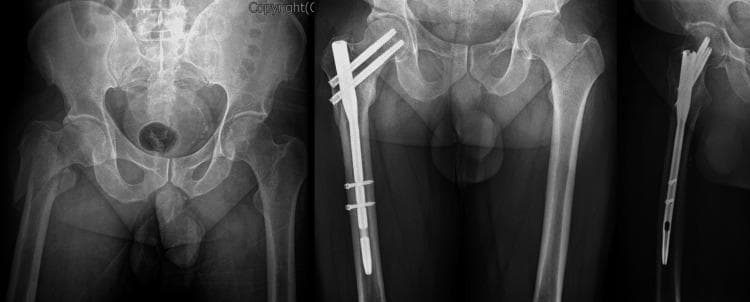 This composite diagnostic image consists of three X-ray radiographs illustrating the surgical management of a proximal femur fracture. The leftmost image is a preoperative AP pelvis radiograph showing a reverse oblique intertrochanteric fracture of the right femur with significant lateral displacement of the distal fragment. The central and rightmost images are postoperative AP and lateral views showing fracture reduction and internal fixation with a Proximal Femoral Nail (PFN). The intramedullary device is secured proximally by two parallel cephalomedullary lag screws extending into the femoral head and neck to provide rotational stability. Distally, the nail is anchored by two transverse interlocking cortical screws in the femoral shaft. This educational content demonstrates orthopedic trauma management for unstable hip fractures using intramedullary nail systems. It is intended for intermediate to advanced medical learners focusing on radiology and orthopedic surgery.
