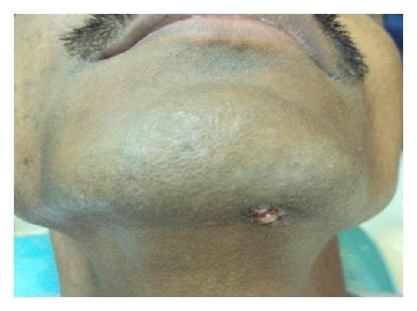A clinical photograph capturing the inferior view of a patient's submental and chin region. The image demonstrates a non-healing, extraoral draining sinus tract located centrally in the submental area. The lesion is characterized by a small, irregular cutaneous opening with evidence of active seropurulent or yellowish discharge. The immediately surrounding skin exhibits localized erythema, swelling, and hyperpigmentation, consistent with chronic inflammation. This clinical presentation is typical of an odontogenic cutaneous sinus tract, which often results from chronic periapical infections such as dental cysts or abscesses that have tracked through the mandibular bone to the skin surface. The image is a significant diagnostic example in both oral surgery and dermatology for identifying extraoral manifestations of dental pathology, such as odontogenic keratocysts or infected periapical cysts.
