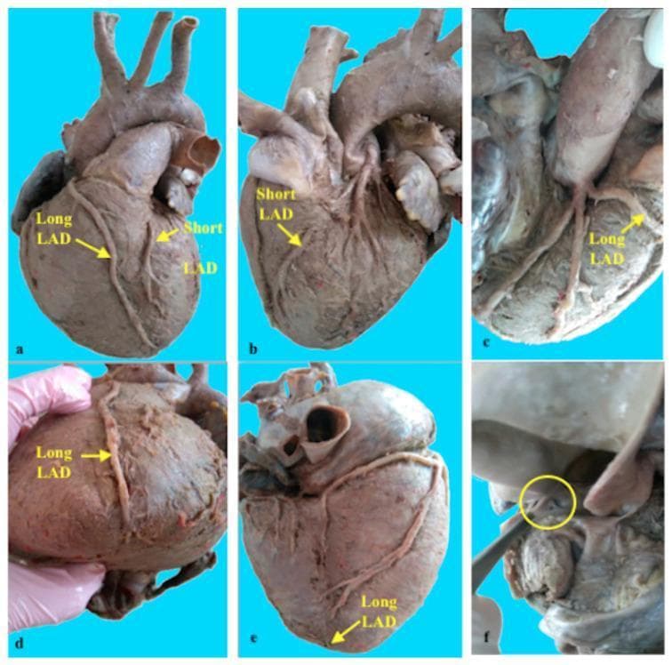 This composite of six clinical photographs (labeled a-f) documents a rare anatomical variant known as a Type XIV double anterior interventricular artery (left anterior descending artery, or LAD). The specimen images highlight the coexistence of a 'Short LAD' and a 'Long LAD' on a human heart. Panels (a) and (b) show the 'Short LAD' originating from the left coronary artery, characterized by a brief course along the anterior interventricular groove and containing a visible muscular bridge in its middle segment. Panels (a), (d), and (e) illustrate the 'Long LAD' extending significantly toward and exceeding the cardiac apex to reach the distal posterior interventricular sulcus. Panels (c) and (f) provide detailed views of the separate aortic origin of the 'Long LAD' from the right coronary sinus. This visual set demonstrates complex coronary artery variations and the presence of myocardial bridging, which are critical concepts in cardiovascular anatomy, diagnostic radiology, and cardiothoracic surgery planning.