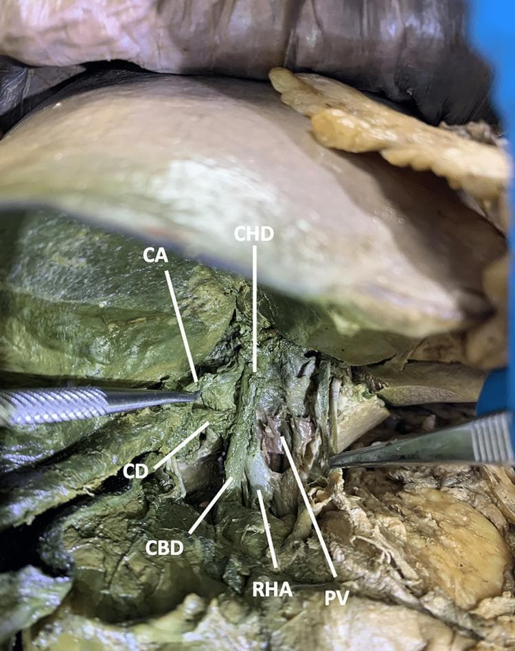 This clinical photograph displays a surgical dissection of the hepatobiliary region in a cadaveric specimen, illustrating the complex anatomy of the cystohepatic triangle (Calot's triangle). The image shows the liver retracted superiorly to reveal the portal triad and its branches. Key anatomical structures are labeled: the Right Hepatic Artery (RHA), Portal Vein (PV), Common Bile Duct (CBD), Common Hepatic Duct (CHD), Cystic Duct (CD), and Cystic Artery (CA). In this specific variation, the RHA follows a course between the PV and the CBD. Within the boundaries of the cystic triangle, a single CA is seen branching off the RHA to supply the gallbladder. Surgical forceps are visible, highlighting the dissection plane. This anatomical illustration serves as a reference for identifying vascular and biliary variations critical for preventing iatrogenic injury during cholecystectomy or hepatobiliary surgery. The educational focus is on the spatial relationships and variable branching patterns of the hepatic arterial system relative to the biliary tree.
