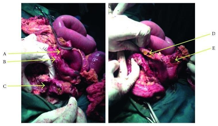 This clinical photograph provides an intraoperative view from an emergency exploratory laparotomy, demonstrating multiple ileal perforations secondary to typhoid fever. The image shows distended loops of the small bowel (ileum) with significant pathological changes. Marked at locations A through E are several distinct intestinal perforations, characterized by ragged, irregular edges and disrupted serosal surfaces. The intestinal wall appears inflamed, edematous, and discolored, with evident denudation of the serosa in multiple spots. Yellowish-green fibrinous exudate and fecal material are visible at the sites of perforation, indicating active fecal peritonitis. Gloved hands and surgical retractors are shown manipulating the bowel to expose the extent of the damage. This visual illustrates the severe surgical complications of typhoid enteritis, specifically typhoid intestinal perforation (TIP), which typically occurs in the distal ileum and requires segmental resection and peritoneal lavage.