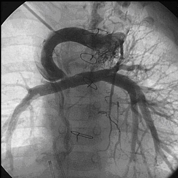 This diagnostic angiogram of the thoracic vasculature illustrates complex post-surgical anatomy in a pediatric patient following palliative cardiac surgery. The central feature is a bidirectional cavopulmonary shunt (Glenn procedure) showing a focal stenosis at the anastomosis site between the superior vena cava and the pulmonary artery conduit. The image demonstrates a prominent, arching aorta and relatively hypoplastic pulmonary arteries. Significant pathology is noted by the presence of numerous, tortuous, and enlarged collateral vessels originating from both internal mammary arteries, which provide compensatory blood flow to the lungs. Several surgical artifacts are visible, including metallic sternotomy wires in the midline and vascular clips along the larger vessels. A metallic coil is also identifiable, indicating a previous interventional coil embolization of collateral vessels. This image serves as a clinical example of postoperative complications in congenital heart disease management, specifically highlighting stenotic shunts and the development of aortopulmonary collaterals.