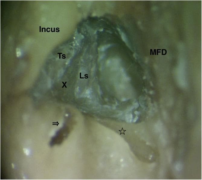 This endoscopic clinical photograph provides a high-magnification view of a surgical dissection of the human left temporal bone, specifically focusing on the facial nerve anatomy. The image demonstrates the labyrinthine segment (Ls) of the facial nerve following the removal of overlying bone. Key anatomical landmarks are labeled: the tympanic segment (Ts) of the facial nerve, the incus, and the middle fossa dura (MFD). The vertical crest (Bill's bar), located at the fundus of the internal acoustic canal, is marked with an 'X'. Additionally, the ampullary ends of the lateral semicircular canal (indicated by an arrow) and the superior semicircular canal (indicated by a star) are visible. The membranous labyrinths have been removed to facilitate clear visualization of these bony boundaries. This view is clinically significant for understanding surgical approaches for facial nerve decompression, particularly at the meatal foramen and the junction of the labyrinthine and tympanic segments.
