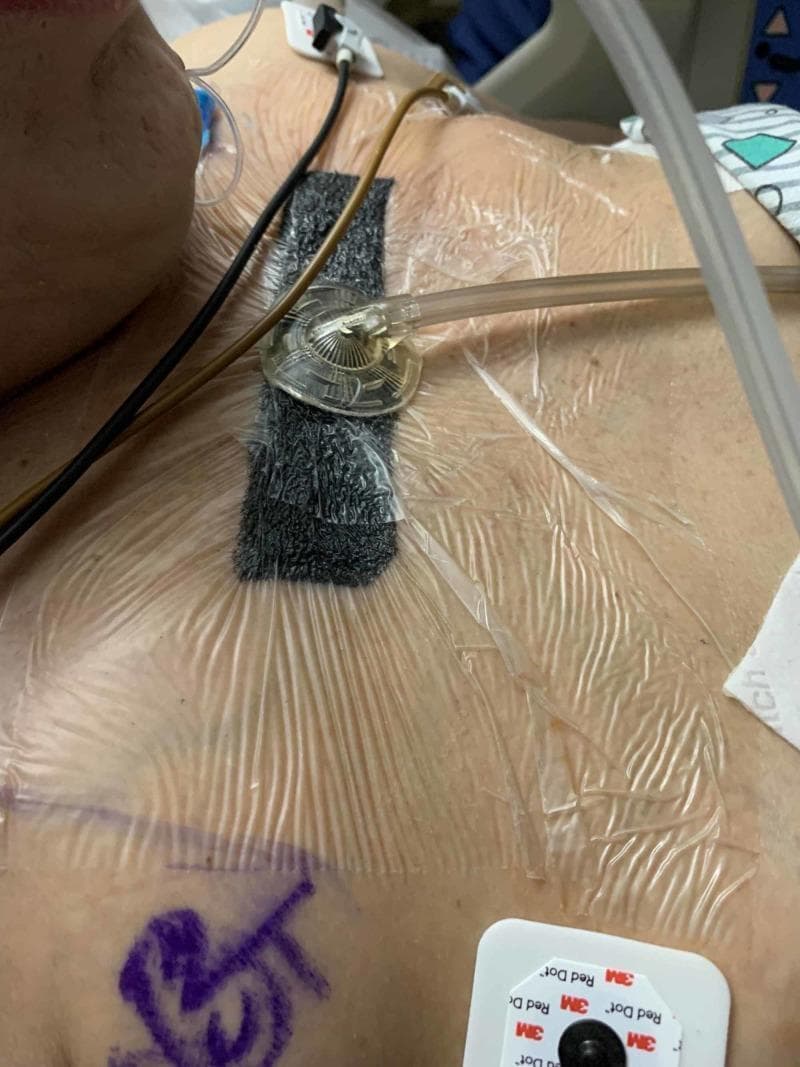 This clinical photograph displays a closed incision negative pressure wound therapy (ciNPWT) system applied to the anterior thoracic region of a patient. Centrally, a rectangular piece of black, reticulated porous foam is visible, secured under a large, wrinkled transparent adhesive drape. A circular suction port with a radial ribbed design is positioned atop the foam, connected to flexible tubing that exits toward the patient's left. The dressing covers loosely approximated 'blow hole' incisions intended to manage massive subcutaneous emphysema. Adjacent to the dressing, several clinical monitoring components are visible, including EKG electrodes (3M Red Dot) and various leads. A purple surgical marking is seen on the lower-left aspect of the chest wall. The image illustrates a specific procedural application for thoracic decompression and wound management in the context of severe chest trauma and air-leak syndromes.