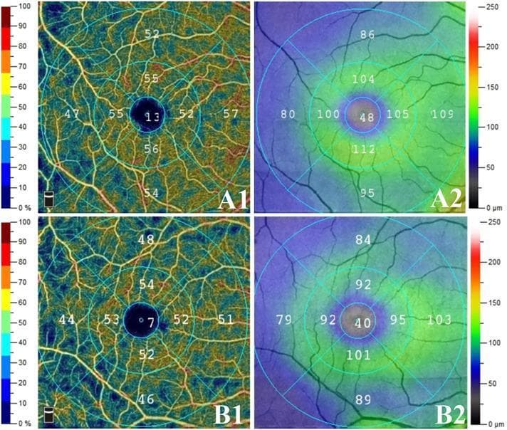 This composite diagnostic image displays Optical Coherence Tomography Angiography (OCTA) scans of the macula, comparing retinal vascular and structural parameters between two clinical states in preclinical diabetic retinopathy. Panels A1 and B1 show heatmaps of the Superficial Capillary Plexus (SCP) vessel density. Panel A1 (Non-Diabetic Nephropathy group) exhibits warmer tones (yellow to orange) and higher numerical density values (e.g., central 13%), indicating a robust microvascular network. Panel B1 (Diabetic Nephropathy group) shows a shift toward cooler blue and green tones with reduced numerical values (e.g., central 7%), signifying microvascular rarefaction. Panels A2 and B2 present Ganglion Cell Complex (GCC) thickness maps. A2 demonstrates thicker tissue (primarily green and yellow hues, values up to 112 µm) compared to B2, which shows thinning of the neurosensory retina indicated by predominant blue hues and lower numerical thickness values (e.g., central 40 µm). Both sets of images utilize an Early Treatment Diabetic Retinopathy Study (ETDRS) grid overlay for regional quantification, highlighting the correlation between diabetic renal status and retinal neurovascular degeneration.