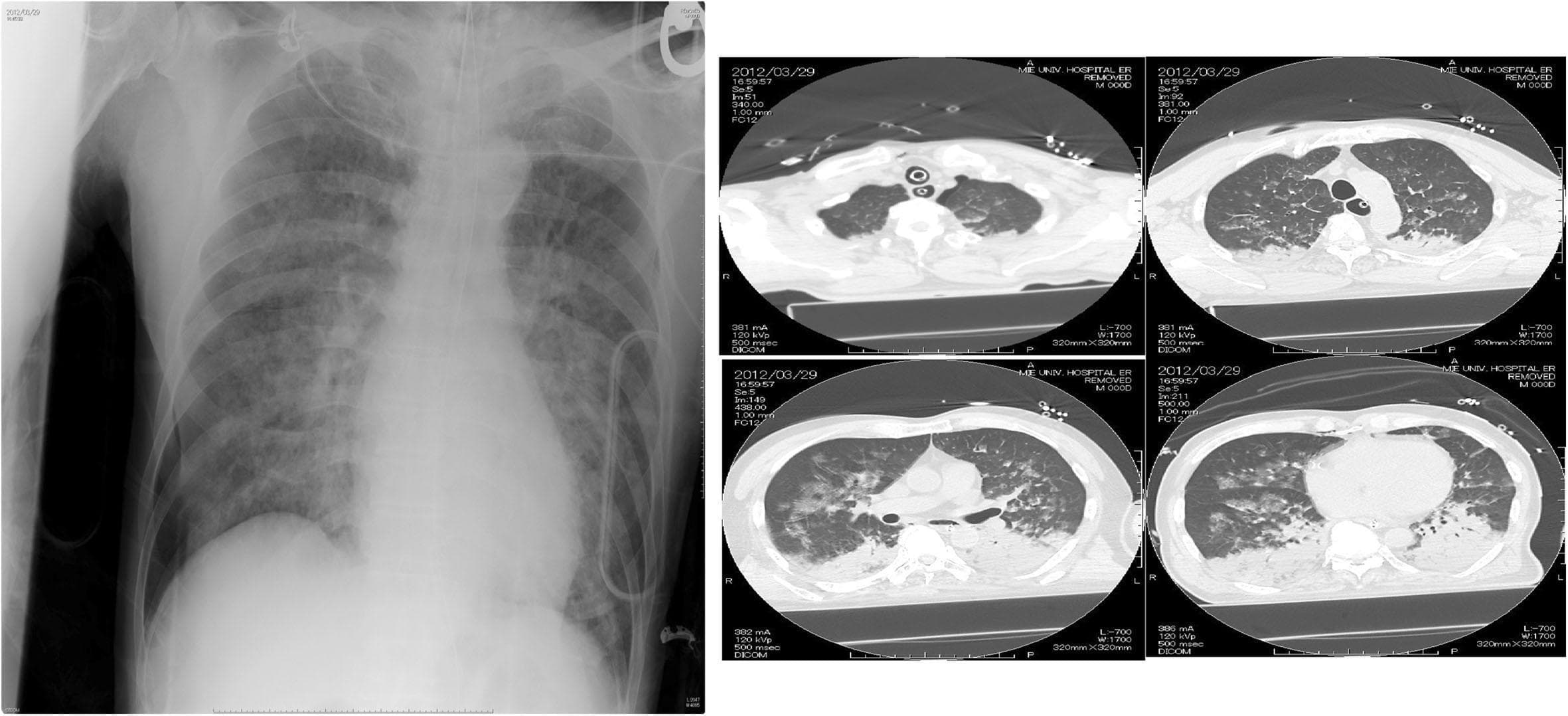 A composite diagnostic image featuring a frontal chest radiograph and multiple axial CT scans of the thorax. The chest X-ray demonstrates diffuse, patchy, bilateral pulmonary opacities and infiltrates involving all lung zones, characteristic of Acute Respiratory Distress Syndrome (ARDS) or extensive pulmonary edema. Normal vascular markings are obscured. The axial CT scan frames confirm widespread bilateral consolidation and ground-glass opacities, localized predominantly in the dependent (posterior) regions of the lungs in a supine patient. Additionally, the CT images reveal pathology in the left hemithorax, including multiple rib fractures and signs of a pneumohemothorax, characterized by air and fluid accumulation in the pleural space. Monitoring equipment, including an endotracheal tube and ECG leads, is visible. This clinical imaging set illustrates complex thoracic trauma and secondary respiratory failure, likely following chest compressions or acute lung injury.