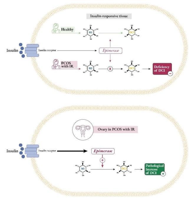 This pathophysiology diagram illustrates the differential regulation of inositol metabolism in classic insulin-responsive tissues versus the ovaries in Polycystic Ovary Syndrome (PCOS) with insulin resistance (IR). The top panel compares healthy and PCOS states in peripheral tissues. In healthy individuals, insulin binding to the insulin receptor activates the epimerase enzyme, facilitating the conversion of myo-inositol (MI) to D-chiro-inositol (DCI). In PCOS with IR, this conversion is blocked (indicated by an 'X'), leading to a 'Deficiency of DCI'. The bottom panel depicts the 'ovarian paradox'. In the ovary of a patient with PCOS and IR, hyperinsulinemia overstimulates the insulin receptor and the epimerase enzyme (indicated by a plus sign and thick arrows). This overactivity causes an excessive conversion of MI to DCI, resulting in a 'Pathological Increase of DCI'. The diagram uses chemical structures for MI and DCI and flow-based signaling pathways to explain how metabolic dysregulation in PCOS leads to tissue-specific inositol imbalances, contributing to endocrine dysfunction.