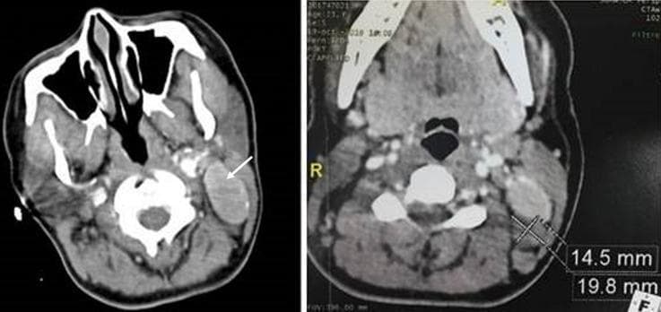 This diagnostic image consists of two axial cervical CT scan slices with intravenous contrast enhancement. The images demonstrate significant lymphadenopathy in the left lateral neck, specifically involving anatomical levels IIB and V. The first image (left) shows a large, well-circumscribed, oblong lymph node at level IIB, indicated by a white arrow, characterized by strong and relatively homogeneous enhancement compared to surrounding musculature. The second image (right) provides a quantitative assessment of a level V lymph node, measuring approximately 14.5 mm by 19.8 mm. Notable surrounding anatomy includes the cervical vertebrae, paraspinal muscles, and portions of the nasopharyngeal airway. The high degree of contrast enhancement in these enlarged lymph nodes is a key diagnostic feature, often associated with hypervascular conditions such as Castleman's disease or certain metastatic processes. This visual is used in medical education to illustrate radiographic neck level classification and the appearance of hypervascular lymphadenopathy.