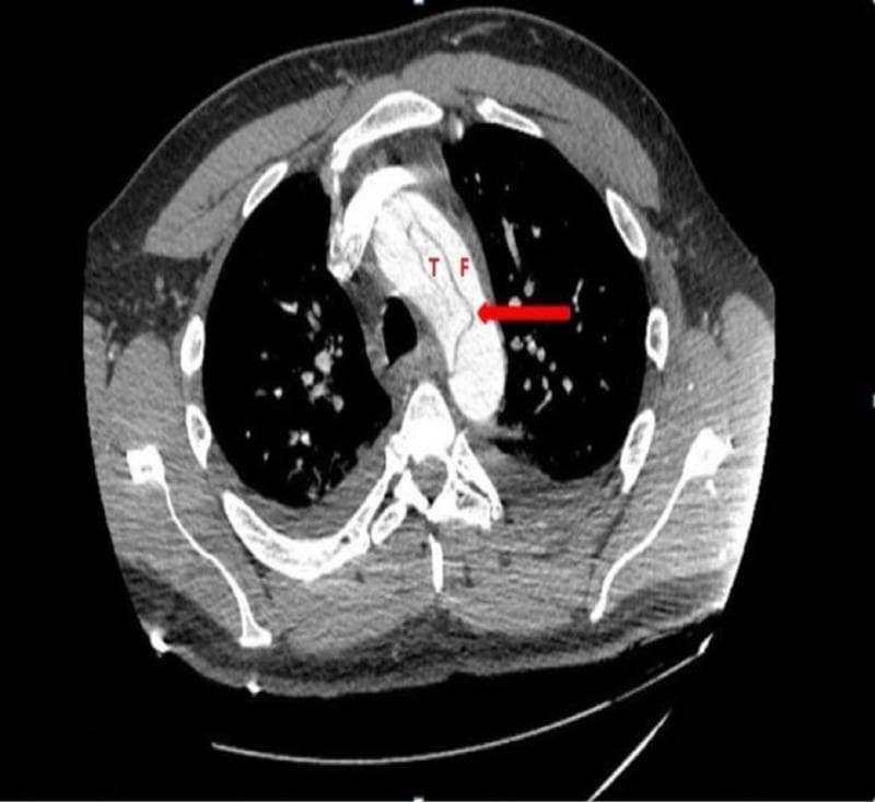 This diagnostic image is an axial contrast-enhanced computed tomography (CT) scan of the thorax at the level of the aortic arch, demonstrating an acute aortic dissection. The primary finding is a thin, linear, hypodense intimal flap that bisects the contrast-filled vessel into two distinct compartments: the true lumen (labeled 'T') and the false lumen (labeled 'F'). A red arrow specifically indicates the location of the intimal tear. The false lumen appears slightly more dilated than the true lumen, a common morphological feature in dissection. The image provides critical visual evidence for diagnosing Stanford Type A aortic dissection involving the arch, highlighting the spatial relationship between the primary entry tear and the newly formed vascular channels. This material is suitable for cardiovascular radiology education, specifically for teaching the identification of intimal flaps and differentiating true vs. false lumina in emergency vascular imaging.