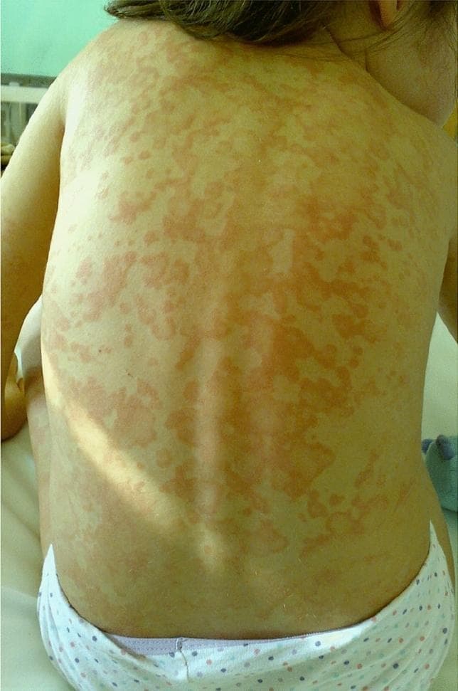 This clinical photograph shows the back of a pediatric patient exhibiting a widespread, salmon-pink erythematous rash. The lesions are distributed extensively across the upper and lower back and shoulders. Morphologically, the rash is composed of discrete macules and slightly raised papules that frequently coalesce into larger, irregularly shaped, nonfixed patches. The borders of the lesions are indistinct and poorly demarcated, blending into the surrounding fair skin. There is a notable absence of scaling, crusting, vesiculation, or blistering. Clinically, this type of evanescent rash is a hallmark cutaneous manifestation of systemic juvenile idiopathic arthritis (sJIA), typically characterized by its transient nature, often appearing during peaks of spiking fever and subsiding as the temperature normalizes. The image serves as a key educational example for diagnosing autoinflammatory disorders through cutaneous physical examination.