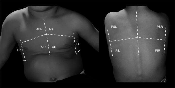 A clinical diagram showcasing a standardized lung ultrasound (LUS) scanning scheme on a pediatric subject. The image is divided into two panels: an anterior-lateral view of the chest and a posterior view of the back. White dashed lines demarcate ten specific scanning regions categorized by anatomical landmarks. Anterior regions include the Anterior Superior Right (ASR), Anterior Inferior Right (AIR), Anterior Superior Left (ASL), and Anterior Inferior Left (AIL), divided by a vertical parasternal line and a horizontal nipple-level line. Lateral areas are marked as Lateral Right (LR) and Lateral Left (LL) along the mid-axillary lines. The posterior panel displays four zones: Posterior Superior Right (PSR), Posterior Inferior Right (PIR), Posterior Superior Left (PSL), and Posterior Inferior Left (PIL), divided by the spinal column and a horizontal mid-scapular line. This protocol is designed for systematic thoracic evaluation, such as monitoring dysphagia-related aspiration or deaeration scores in infants, ensuring comprehensive coverage of all lung lobes during diagnostic imaging.