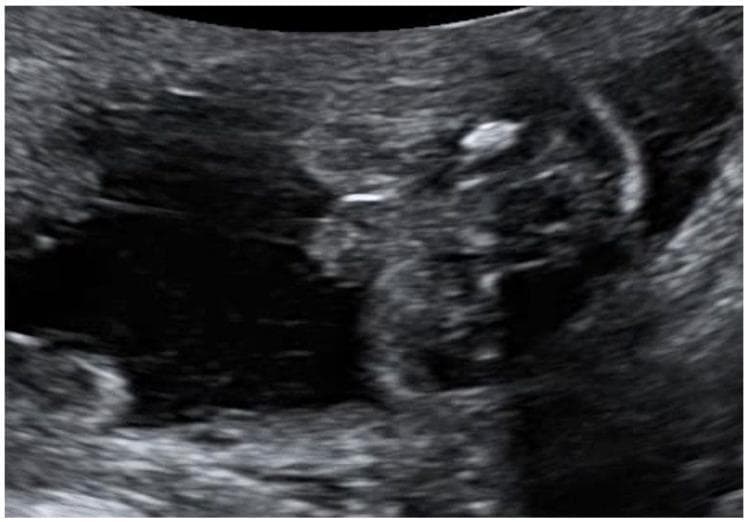 This grayscale diagnostic ultrasound image captures the external fetal genitalia of a 20-week gestation fetus in the axial plane, demonstrating the 'tulip sign' associated with ambiguous genitalia. The key sonographic feature is the lateral displacement and splaying of the labioscrotal folds, which appear as two echogenic, curved structures flanking a central, smaller, hypoechoic genital tubercle (phallus). This configuration mimics the petals of a tulip enclosing a central bud, a classic marker for severe hypospadias or micropenis with bifid scrotum in a 46, XY fetus. The surrounding environment shows anechoic fluid, though the volume is reduced, consistent with oligohydramnios. This visual is significant for prenatal diagnosis of disorders of sexual development (DSD) and complex genetic conditions such as MIRAGE syndrome. The image illustrates fundamental fetal anomaly scanning techniques, focusing on urogenital morphology and the identification of atypical genital development in the second trimester.