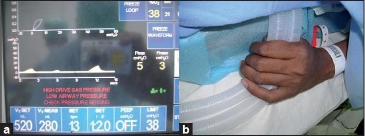 This composite clinical figure illustrates a case of intraoperative awareness and inadequate depth of anesthesia leading to mechanical ventilation complications. Figure 1a is a diagnostic image showing a ventilator monitor display with critical alarms: 'HIGH DRIVE GAS PRESSURE', 'LOW AIRWAY PRESSURE', and 'CHECK PRESSURE SENSING'. Ventilator parameters indicate a significant discrepancy between the set tidal volume (Vt SET: 520 mL) and measured tidal volume (Vt MEAS: 280 mL), with low maximum (Pmax: 5 cmH2O) and mean (Pmean: 3 cmH2O) airway pressures. Figure 1b is a clinical photograph demonstrating the cause of the ventilator abnormality: the patient's hand is visible beneath surgical drapes, tightly gripping and squeezing the corrugated anesthesia breathing circuit tubes. This physical obstruction, caused by the patient's involuntary motor response during light anesthesia, explains the altered pressure waveforms and volumes shown on the monitor. The image serves as an educational tool for anesthesiology, highlighting the importance of monitoring anesthetic delivery systems and recognizing physical causes for ventilator malfunctions.