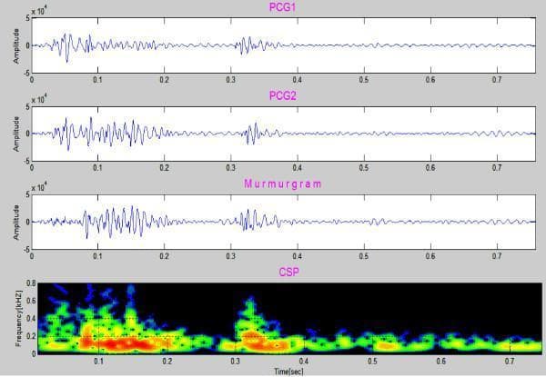 This diagnostic image displays a four-panel comparative analysis of cardiac acoustics in an 8-year-old patient with aortic stenosis. The top two panels, PCG1 and PCG2, show consecutive phonocardiogram waveforms plotted as amplitude over a 0.7-second interval. The third panel, labeled 'Murmurgram', illustrates the result of a signal subtraction method used to isolate abnormal heart sounds. The fourth panel is a Color Spectrogram (CSP), which provides a time-frequency analysis of the cardiac cycle. The CSP shows frequency components on the y-axis (kHz) and time on the x-axis, with color intensity indicating amplitude. Notably, the murmurgram demonstrates a non-flat, high-amplitude signal between S1 and S2, indicating a systolic murmur. The corresponding CSP highlights a concentration of frequency components extending up to approximately 400 Hz (0.4 kHz), peaking in mid-systole (0.1–0.2 seconds). This visual data characterizes the harsh mid-systolic murmur typical of aortic stenosis, localized between the first and second heart sounds.